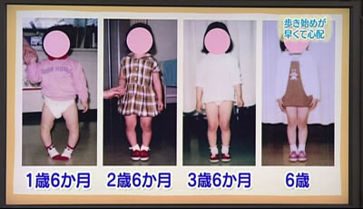 歩き始めが早いとo脚になりやすい 子育てに役立つ情報満載 すくコム Nhkエデュケーショナル