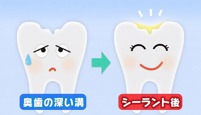 奥歯の深い溝とシーラント後の歯のイメージ