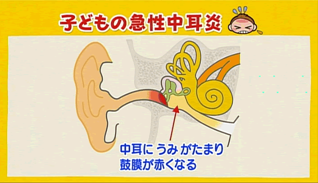 急性中耳炎