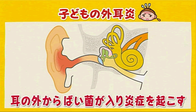 外耳炎