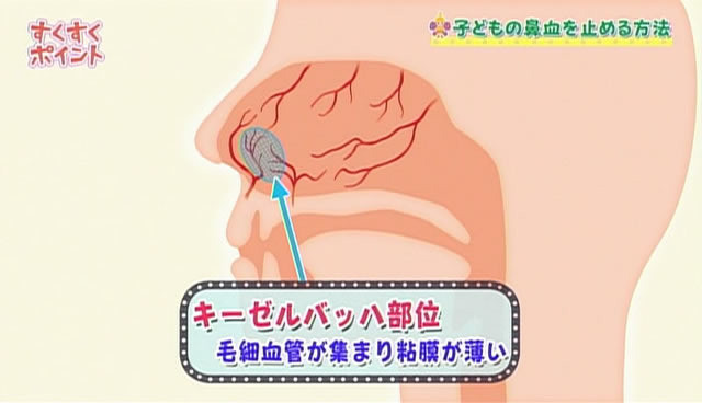 鼻血 が よく 出る 病気