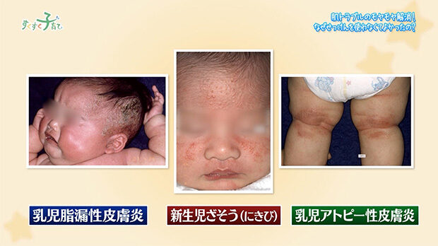 乳児脂漏性皮膚炎・新生児ざそう（にきび）・乳児アトピー性皮膚炎